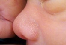 Milia di Hidung: Kenali Penyebab dan Cara Mengatasinya