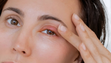 Mata Bintitan Bikin Tak Nyaman? 3 Cara Cepat dan Aman Mengatasi Sendiri di Rumah