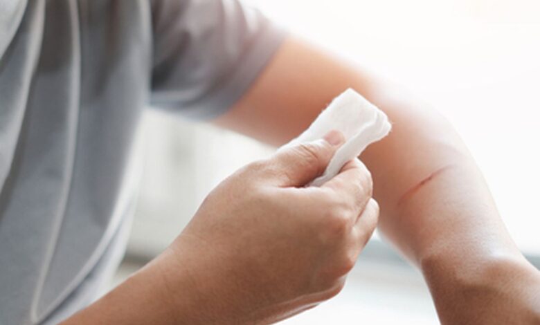 Ini 3 Prinsip Dasar Merawat Luka Ringan: Clean, Cover, and Care